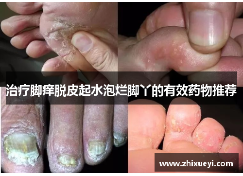 治疗脚痒脱皮起水泡烂脚丫的有效药物推荐