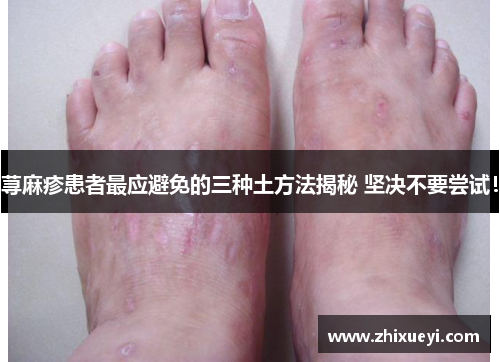 荨麻疹患者最应避免的三种土方法揭秘 坚决不要尝试！